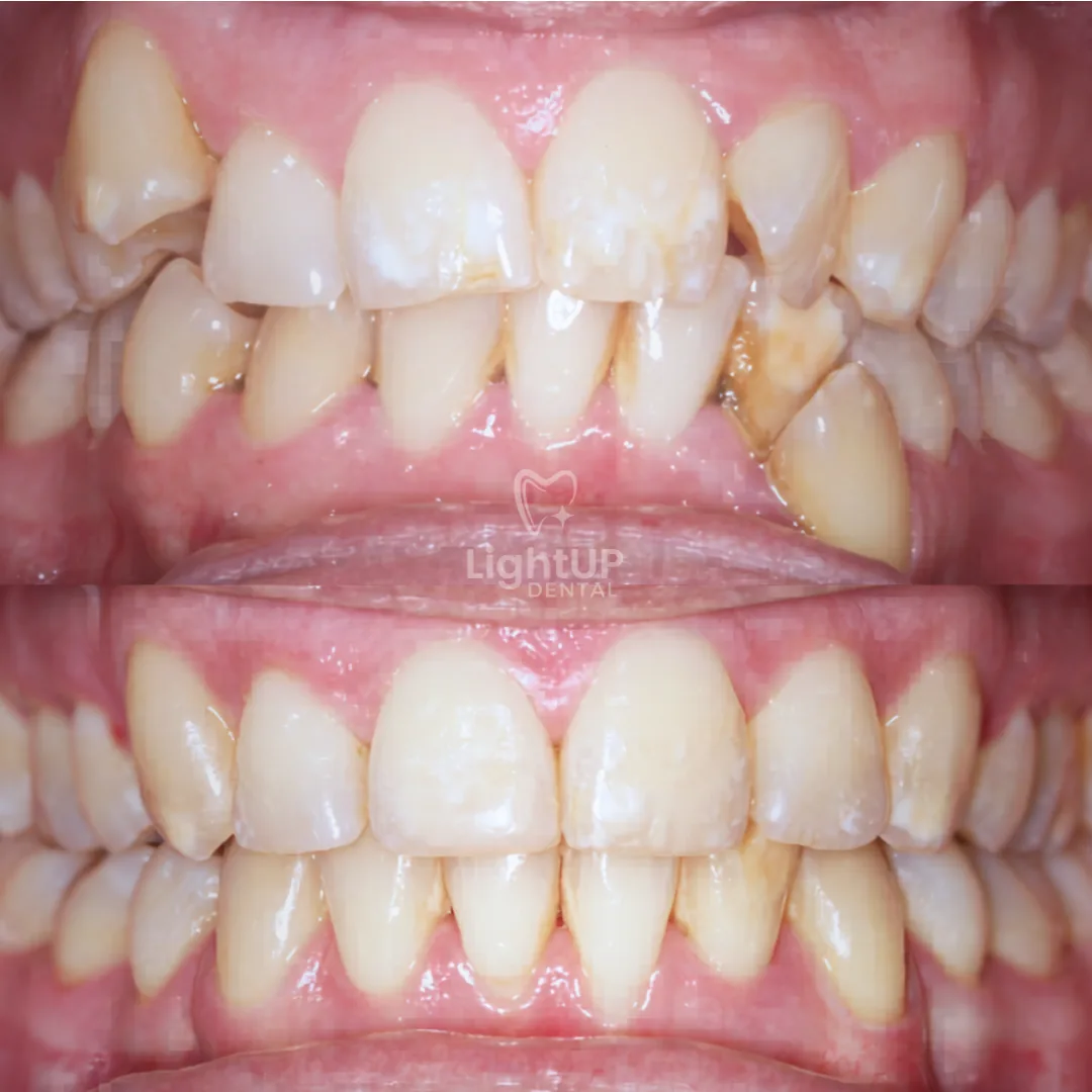 Braces — before and after