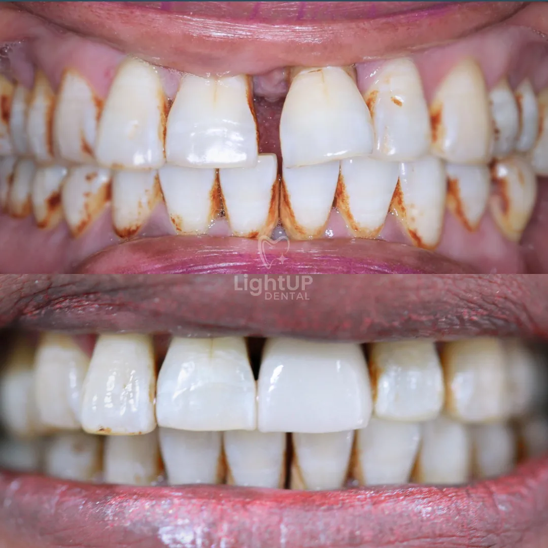 Dental Implant — before and after