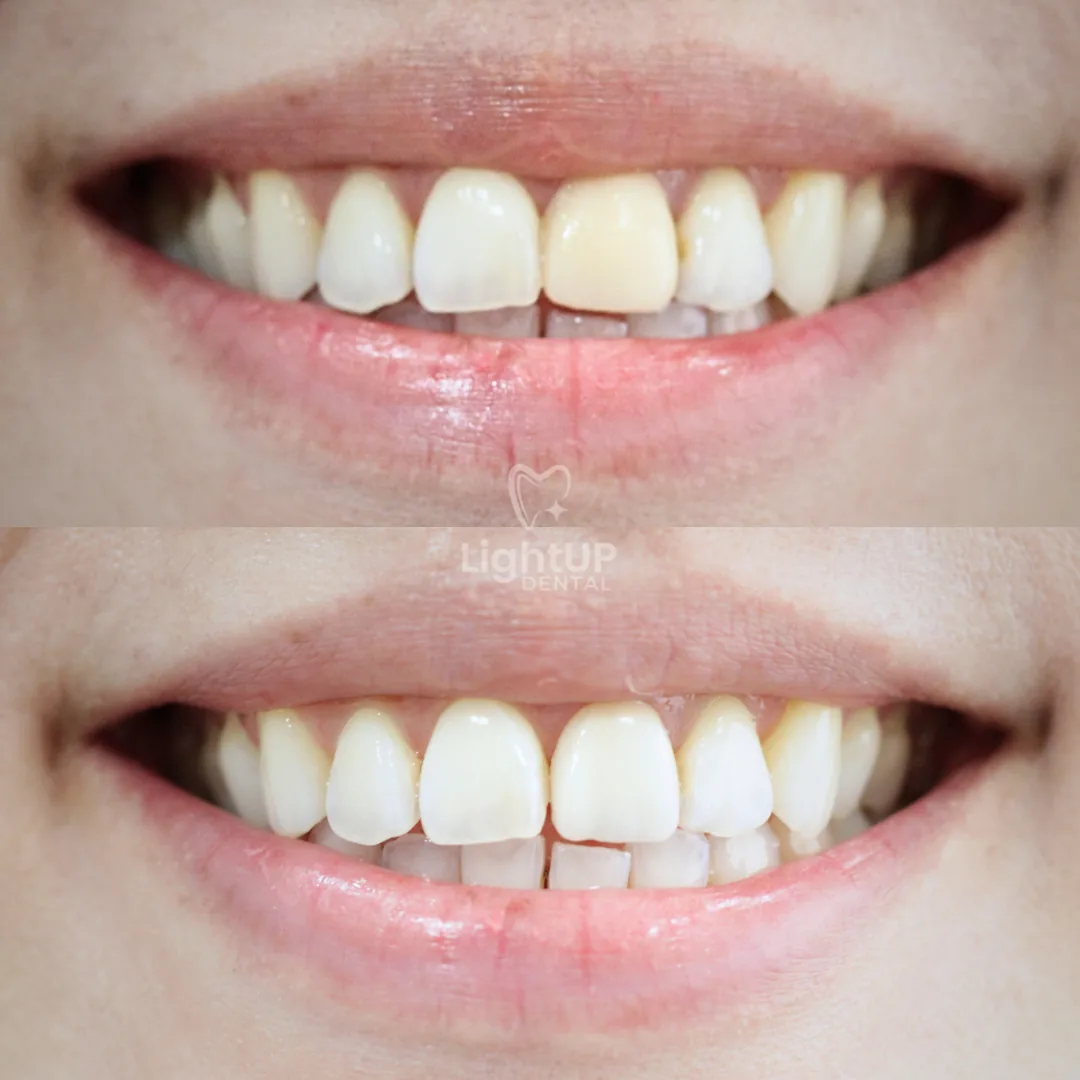 Teeth Whitening + Porcelain Veneer
(one tooth) — before and after