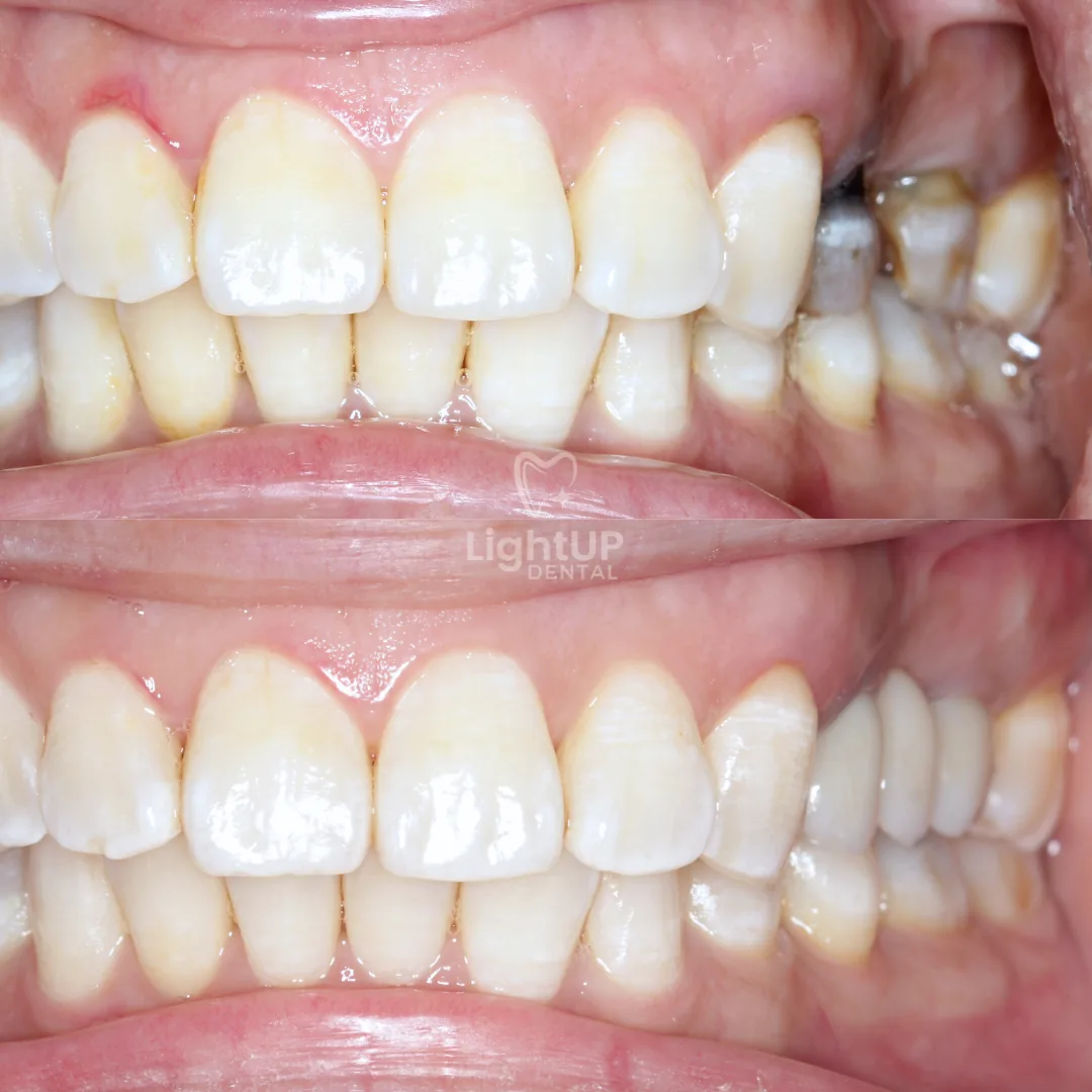 Dental Bridge — before and after